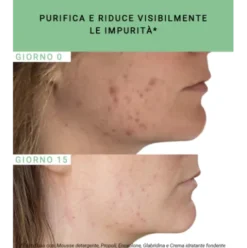 Etat Pur Propoli 750ppm - Attivo antimperfezioni per pelle acneica - 15 ml