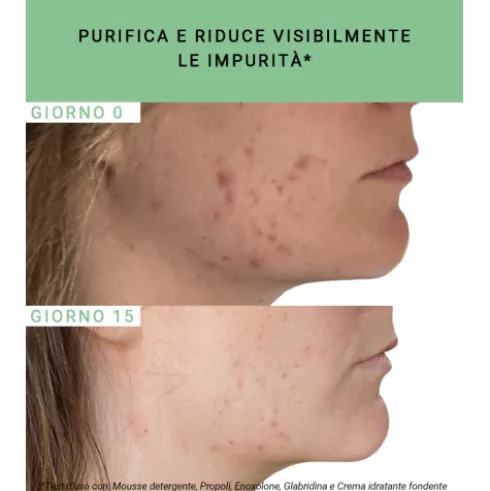 Etat Pur Propoli 750ppm - Attivo antimperfezioni per pelle acneica - 15 ml